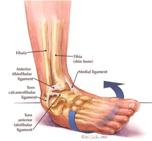 ankle sprain explained